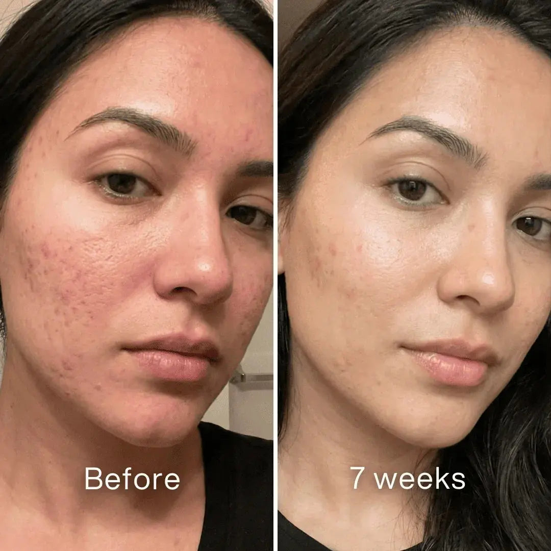 Clinical Acne Scar Repair Stick™